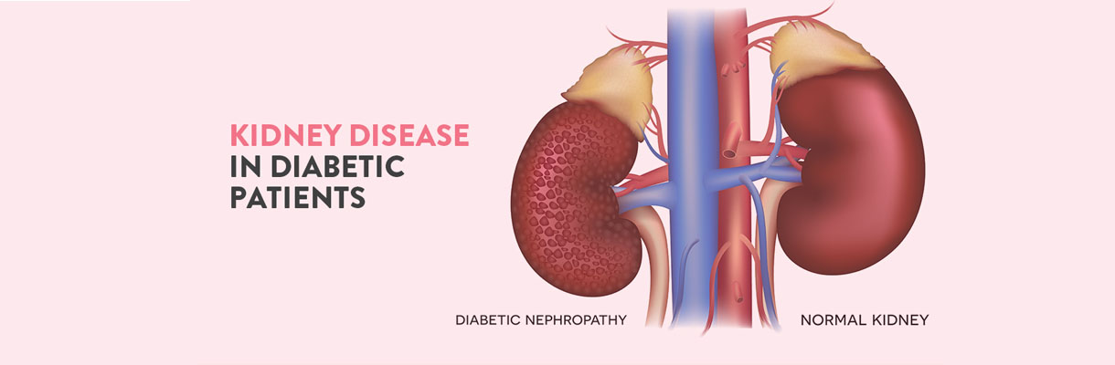 A visual showing kidney disease in diabetics, highlighting the connection.