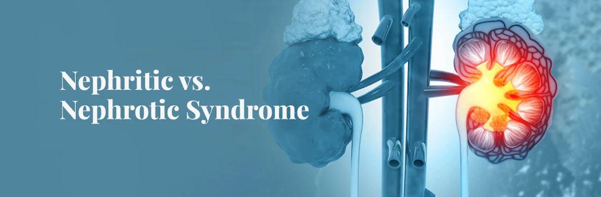 An illustration comparing neuropathy and nephritic syndrome.